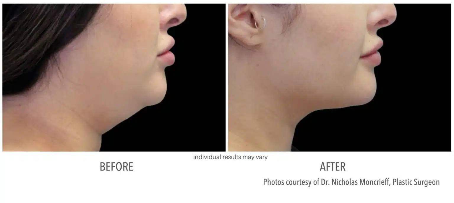 Woman's chin before and after coolsculpting treatment.