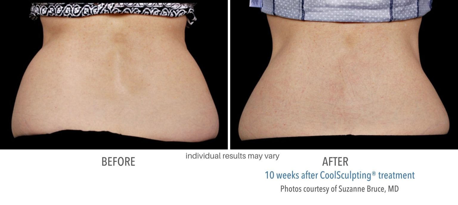 https://www.kpaesthetics.com/wp-content/uploads/2020/09/coolsculpting_before_and_after_newtown_square_4-1-1536x688-2.jpg
