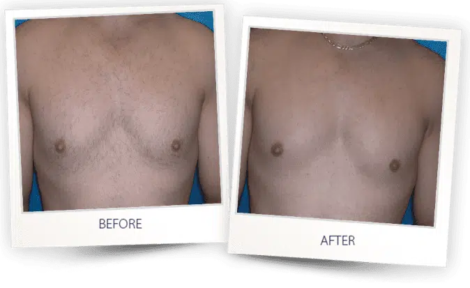 chest of a man before laser hair removal and after