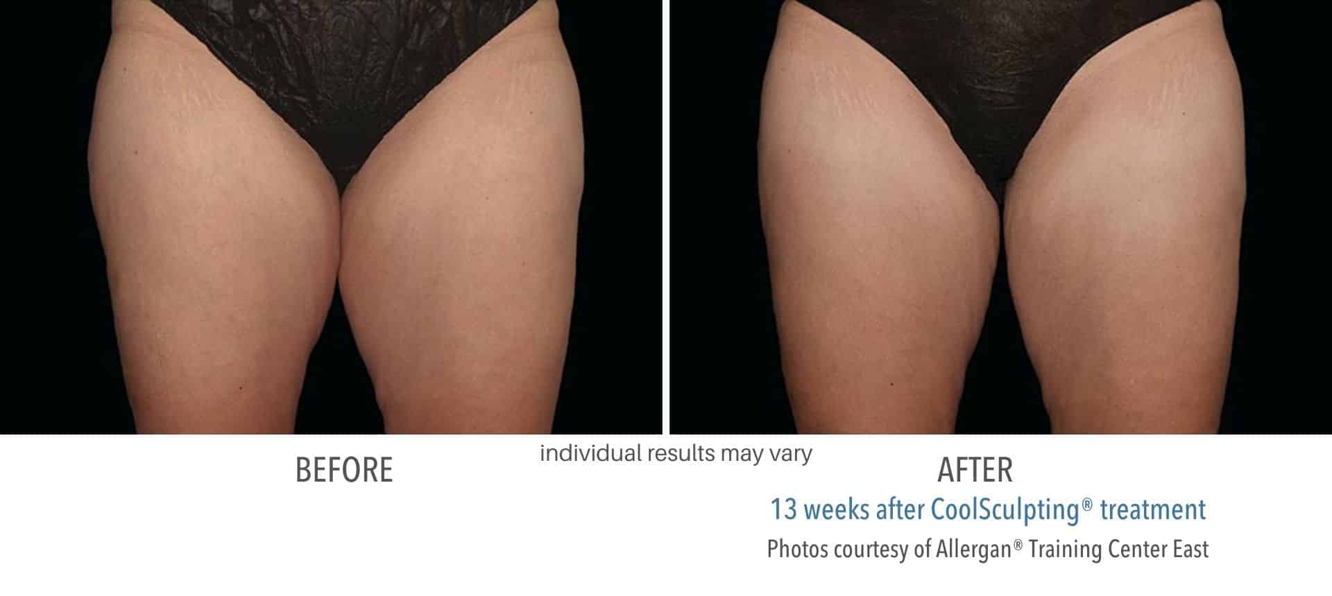 Striving for a Thigh Gap? How CoolSculpting Can Help - DaVinci Body  Sculpting
