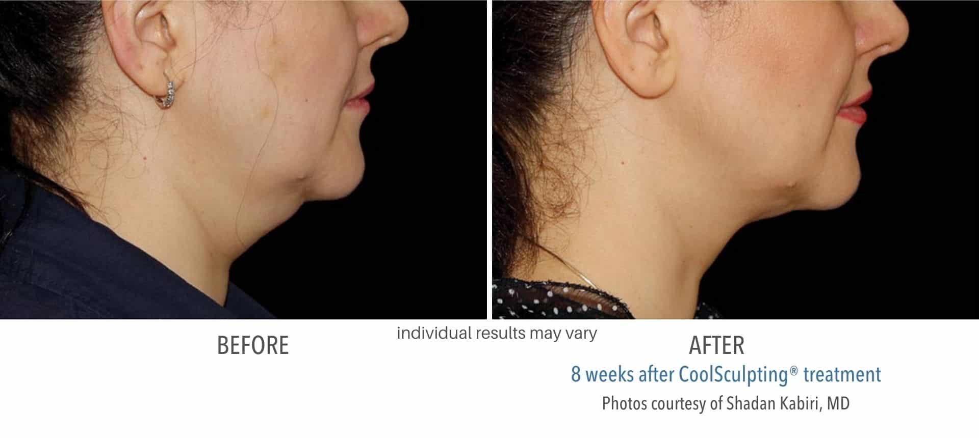 Jawline sculpting before and after: the best treatments for a