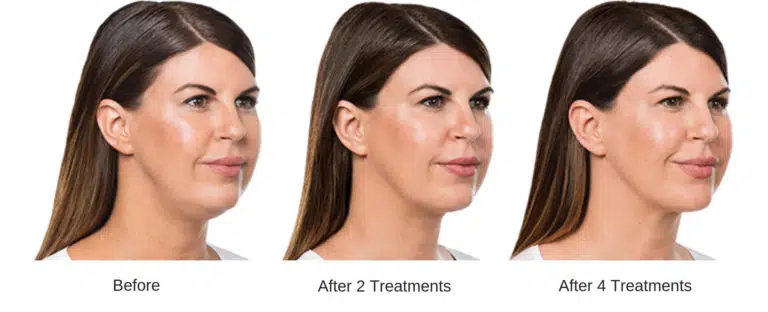 woman after a couple rounds of kybella