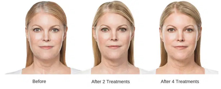 portrait image of a woman after two kybella double chin sessions