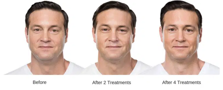 Man's kybella double chin removal results.