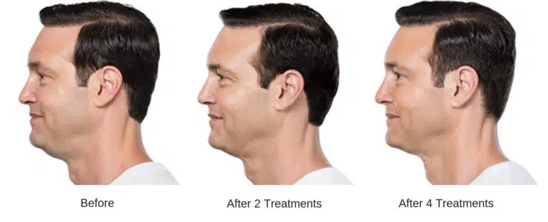 Man's before and after kybella treatment results.