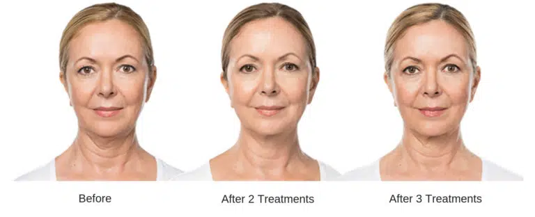Woman's before and after kybella double chin removal
