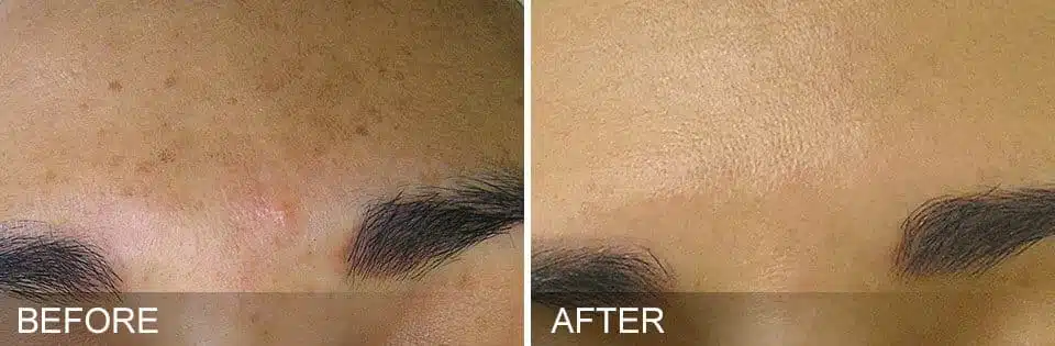 HydraFacial Before and After-4