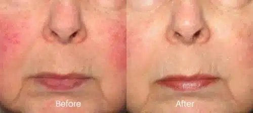 before and after treatment of IPL in Newtown Square, PA