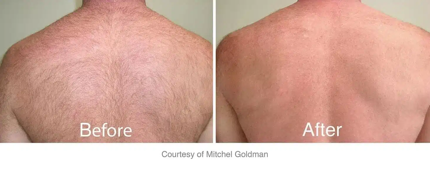 Laser Hair Removal before and after treatments in Philadelphia