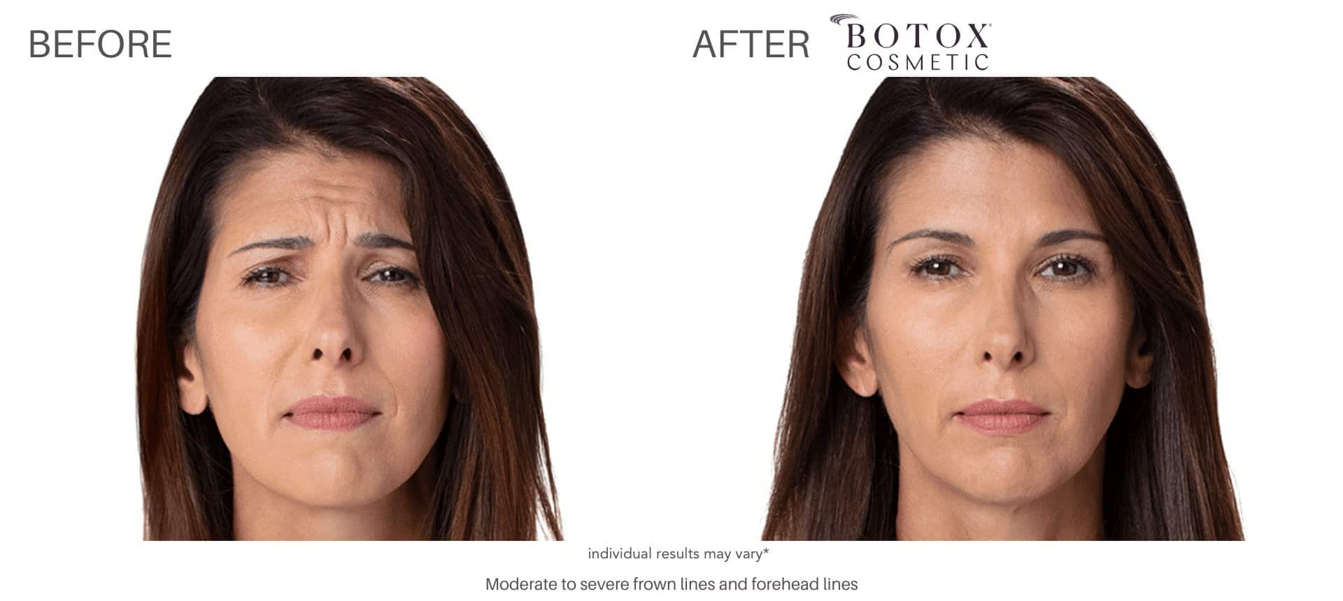 Botox before and after