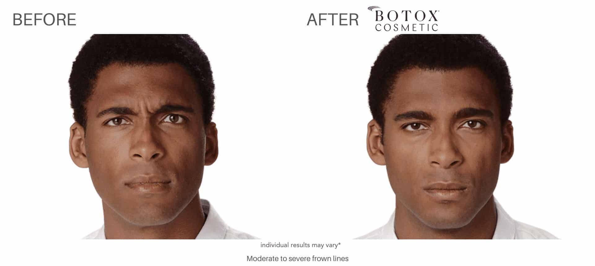 Botox before and after