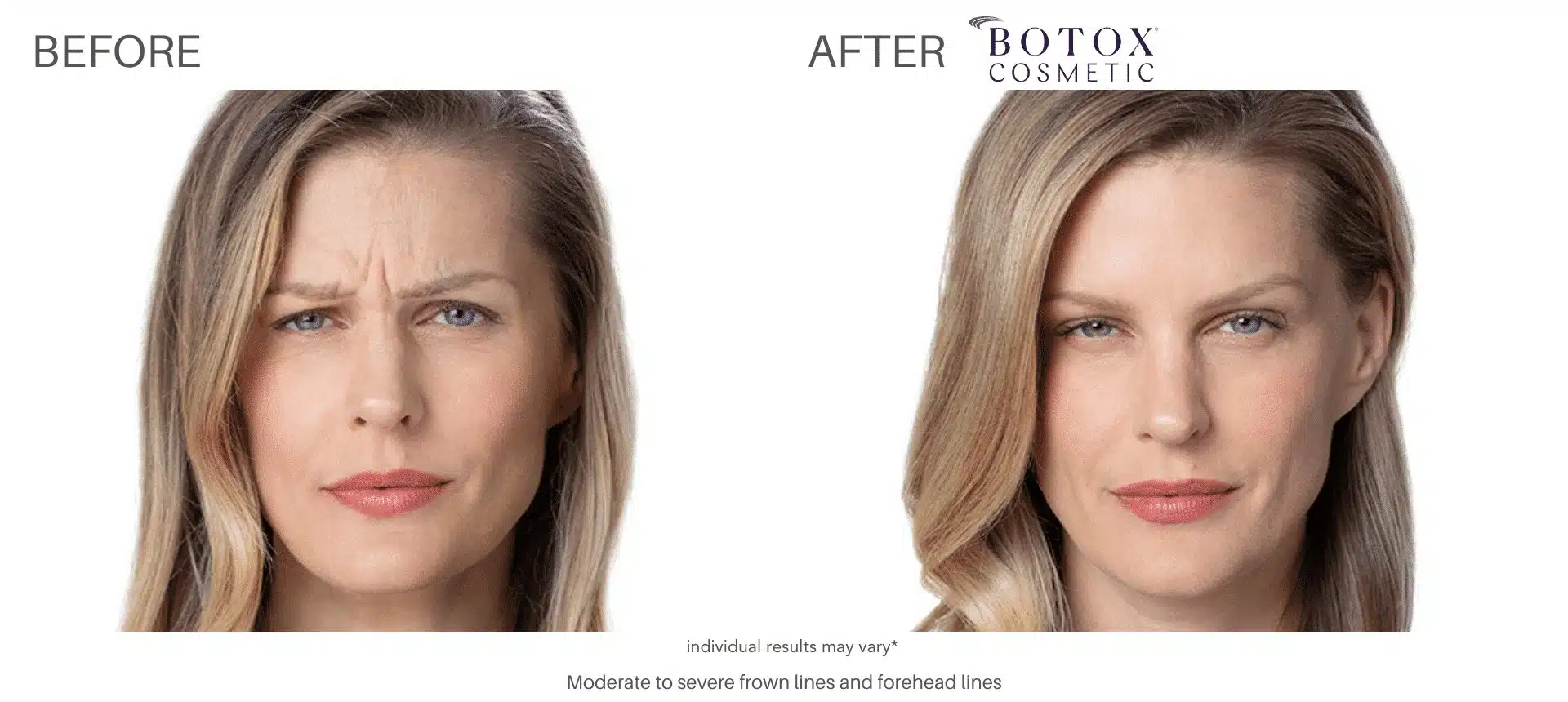 Botox before and after 1