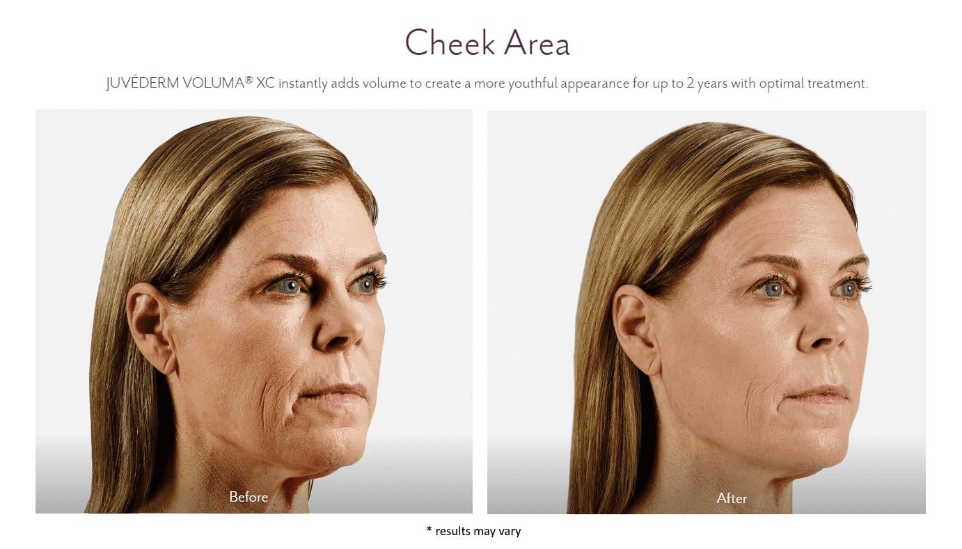 juvederm_before_and_after_10_11zon