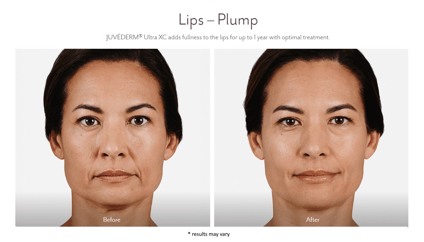 juvederm_before_and_after_6_11zon